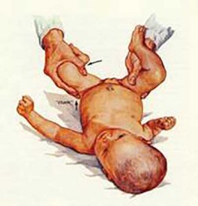 diagnosi_anca