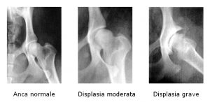 lastre_displasia_anca1